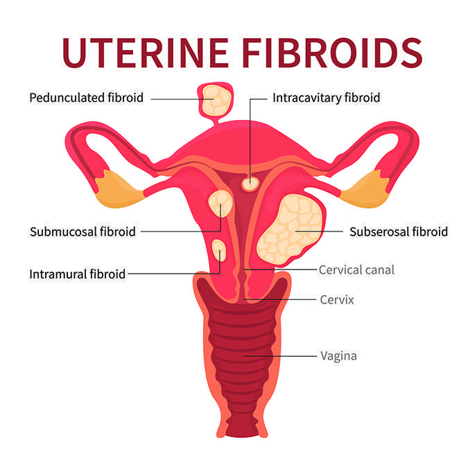 Uterine Fibroid Illustration
