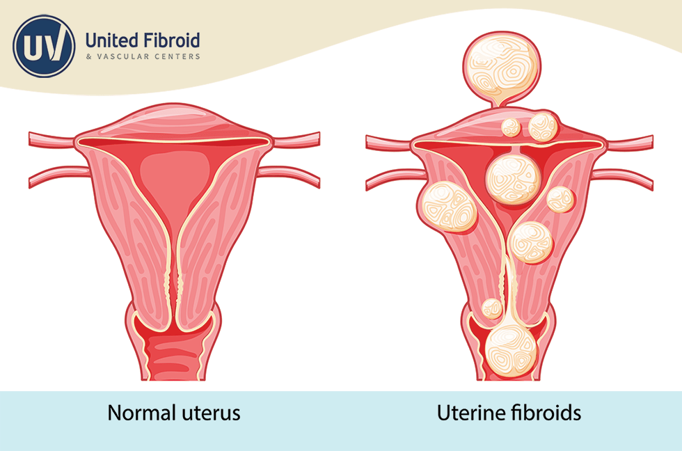What size fibroids should be removed?