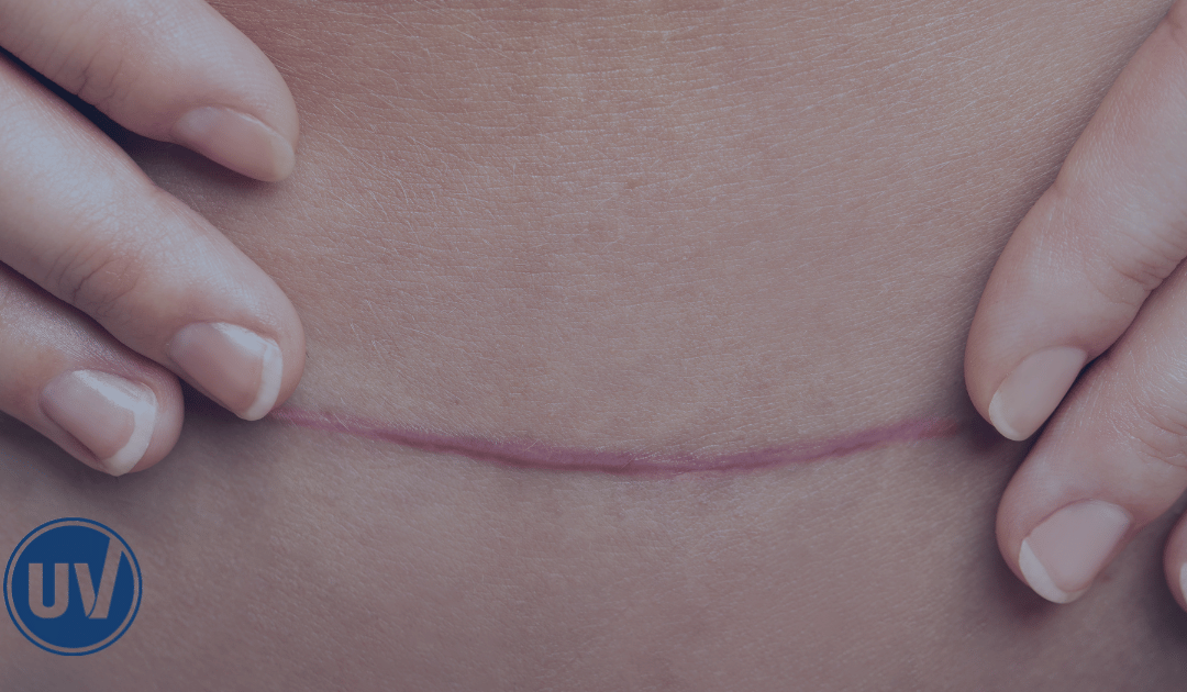 Alternatives to Hysterectomy: Non-Surgical Treatment Options